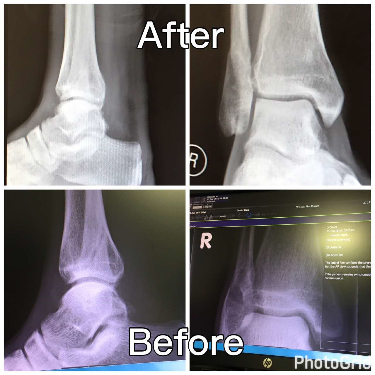 lateral malleolus fracture bruising lateral malleolus fracture bruising