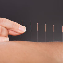Acupuncture (15mins)