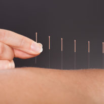 Acupuncture (15mins) Acupuncture (15mins)